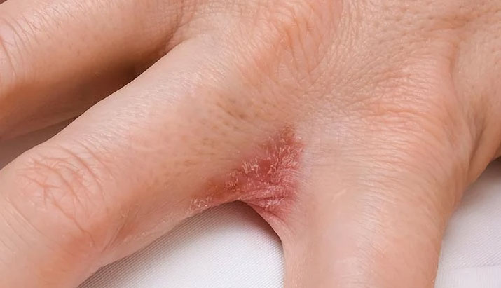 Stop-Eczema-Itching