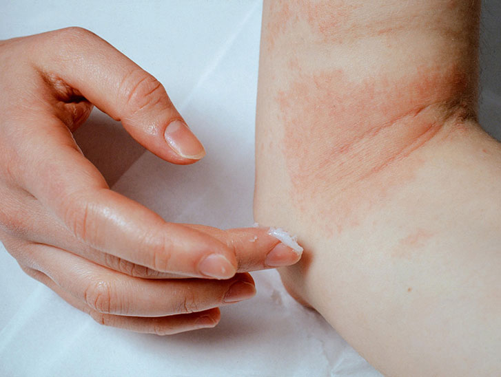 Stop-Eczema-Itching1