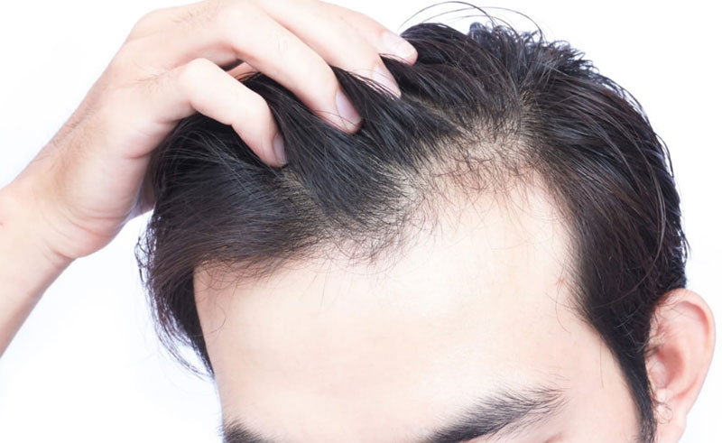consequences-of-rapid-hair-loss1