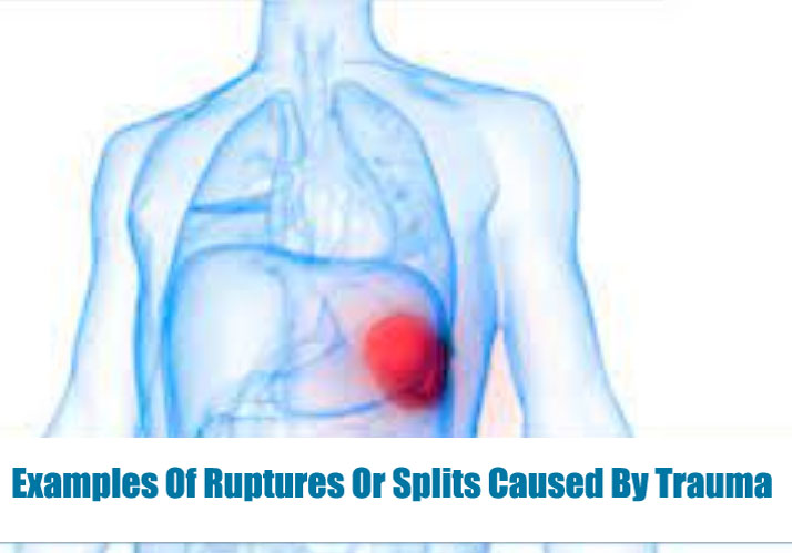 ruptures-caused-by-trauma2
