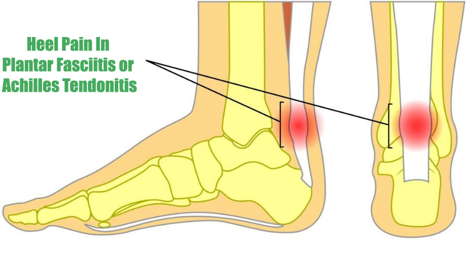 treat-heel-pain-from-plantar-fasciitis1